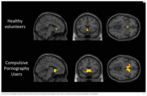 does porn cause brain damage|Pornography addiction: A neuroscience perspective